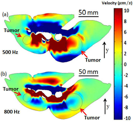 Simulation of sound transmission in lung with tumor